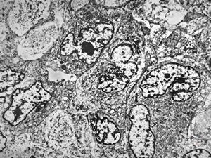 M,51y. | myosarcoma v.s. - scrotum